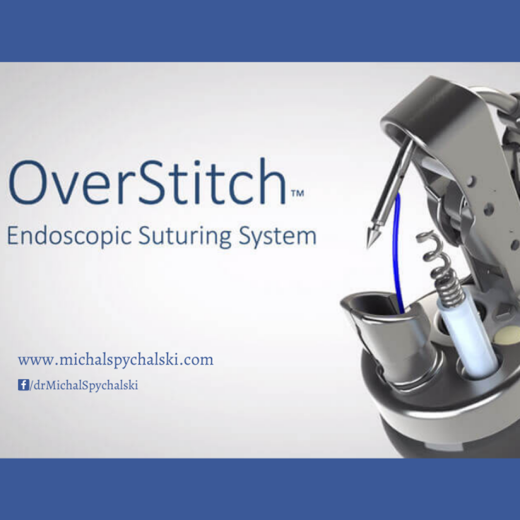endoskopowe zmniejszanie żołądka OverStitch