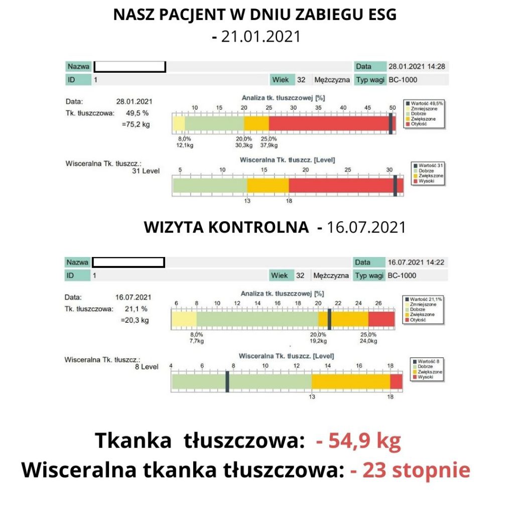 Analiza składu ciała zabieg endoskopowego zmniejszania żołądka